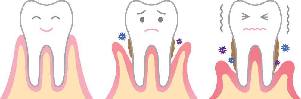 歯周病（歯槽膿漏）とは